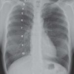 Evaluar la inspiración en una radiografía de tórax