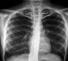 Valoración de la rotación de una radiografía de tórax