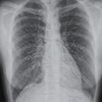 Identificación de la anatomía pulmonar normal en la radiografía frontal de tórax