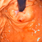 Lesión de Dieulafoy