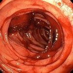 Causas e incidencia de los diverticulos duodenales