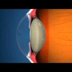 Mecanismo de acomodación del cristalino