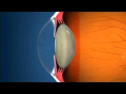 Mecanismo de acomodación del cristalino