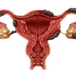 Bases fisiopatológicas del manejo de endometriosis