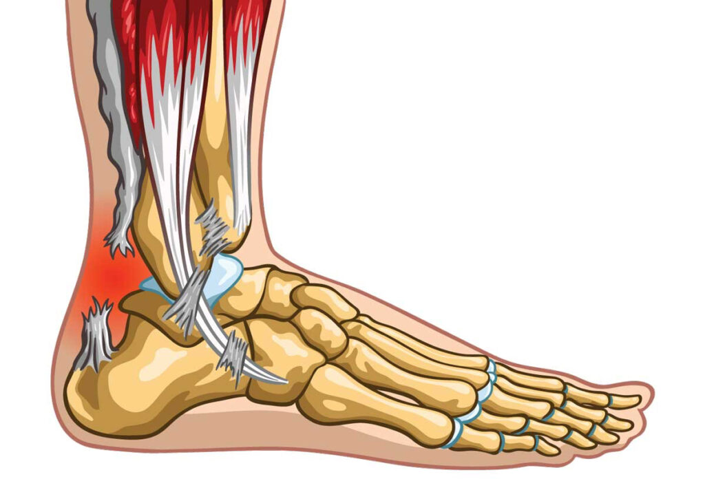 Ruptura del tendón de Aquiles