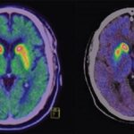 Tecnologías de detectores en tomografía por emisión de positrones