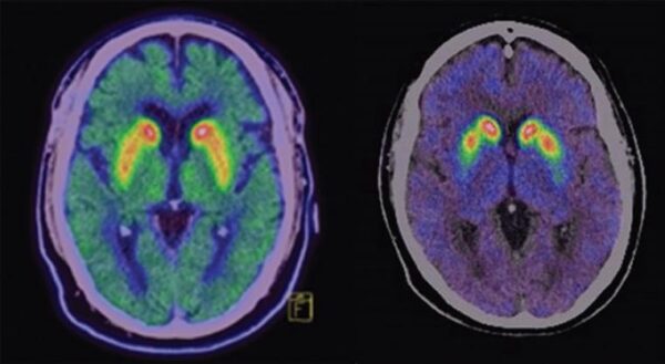 Tecnologías de detectores en tomografía por emisión de positrones