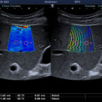Métodos de la elastografía