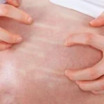 Prurito en el embarazo