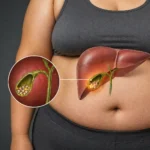 FACTORES DE RIESGO PARA LA ENFERMEDAD POR CÁLCULOS BILIARES