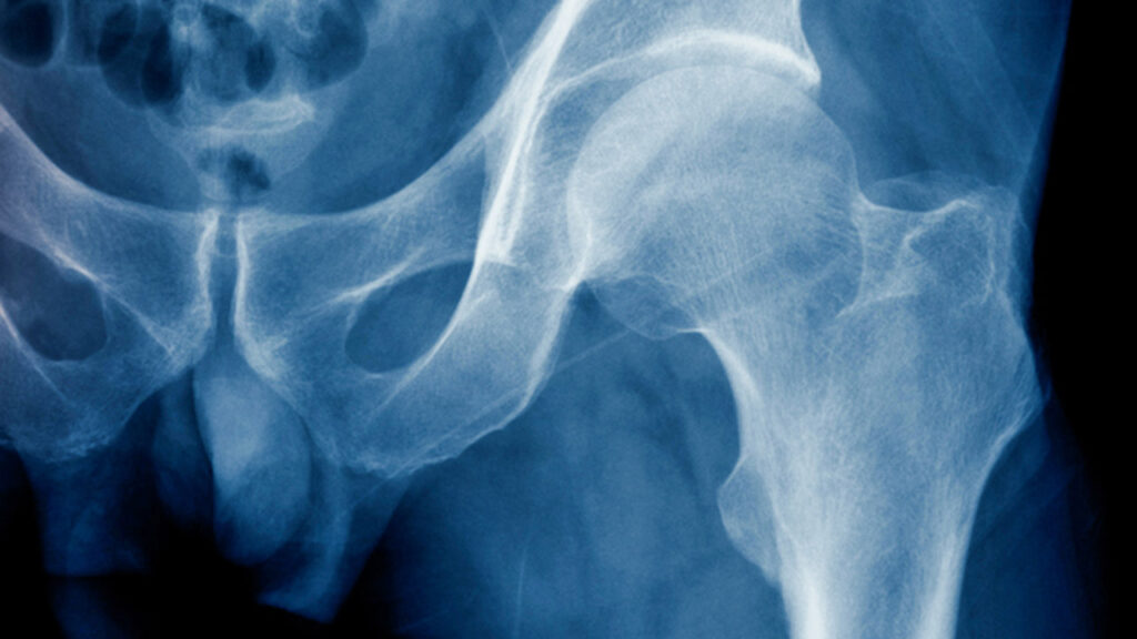 ¿Qué determina la resistencia ósea?