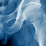 ¿Qué determina la resistencia ósea?