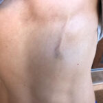 Enfermedad de Mondor