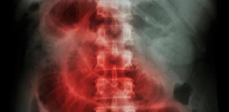 Causas de la obstrucción del intestino delgado
